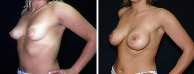 Breast_Implant_Deflation_01b